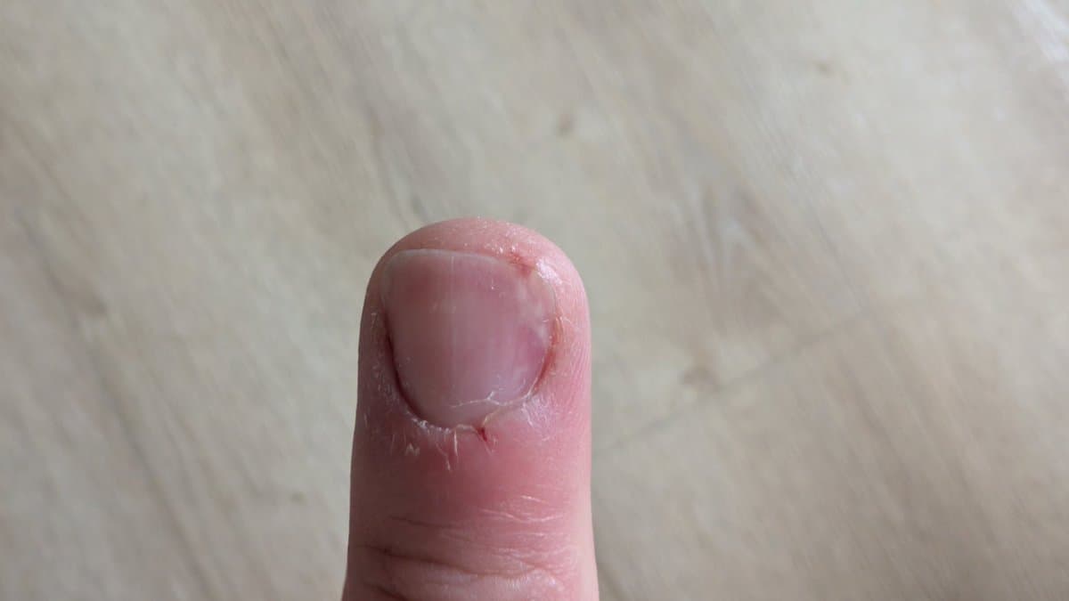 Fingertip with puncture wound from soldering iron, showing red inflammation and blister formation from accidental injury during Mega-CD storage.