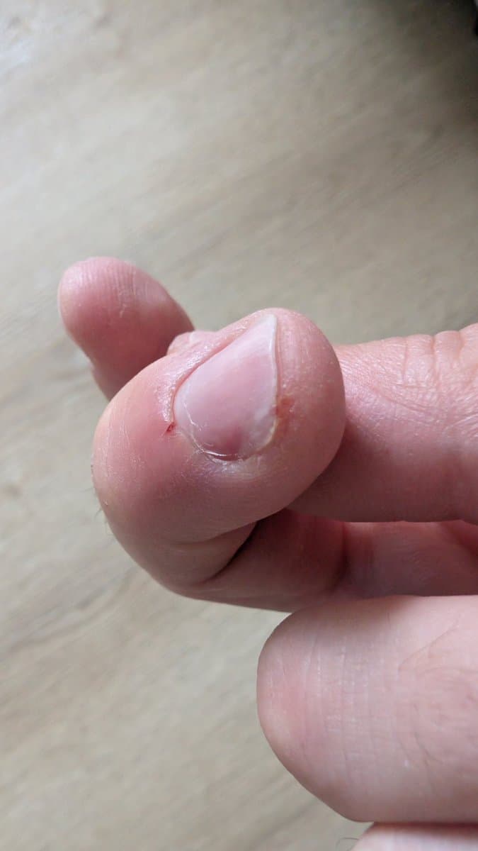 Fingertip with small puncture wound from soldering iron, sustained during Mega-CD 1 restoration work.